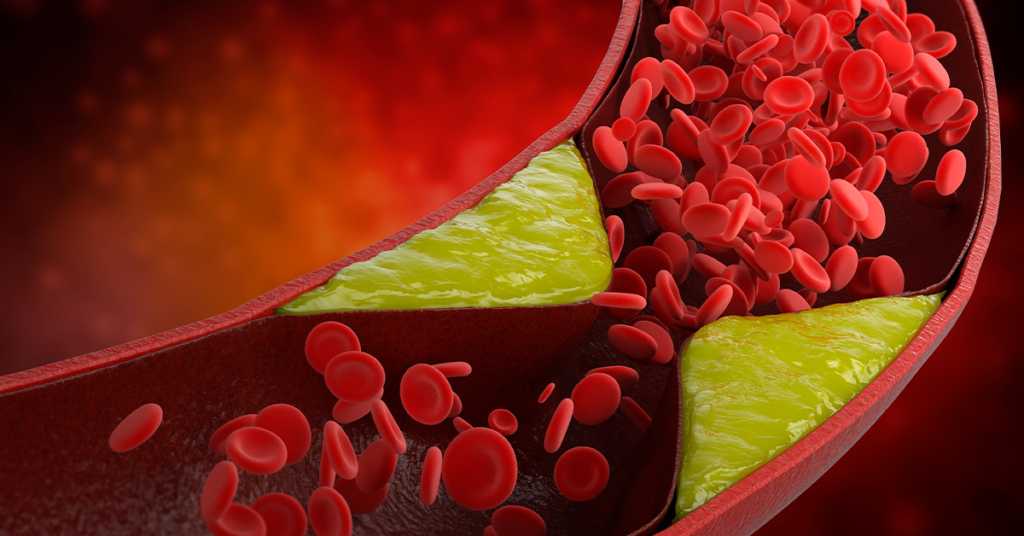 Nutricionista Dislipidemia